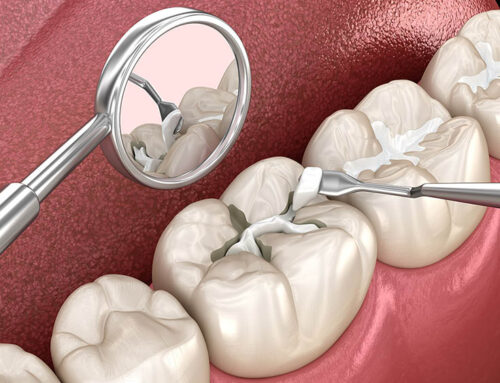 The Positives and Negatives of Dental Sealants