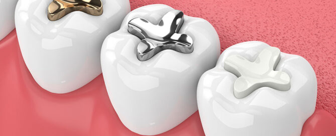 Dental Tooth Filling Types